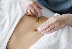 Криолиполиз: коррекция фигуры холодом